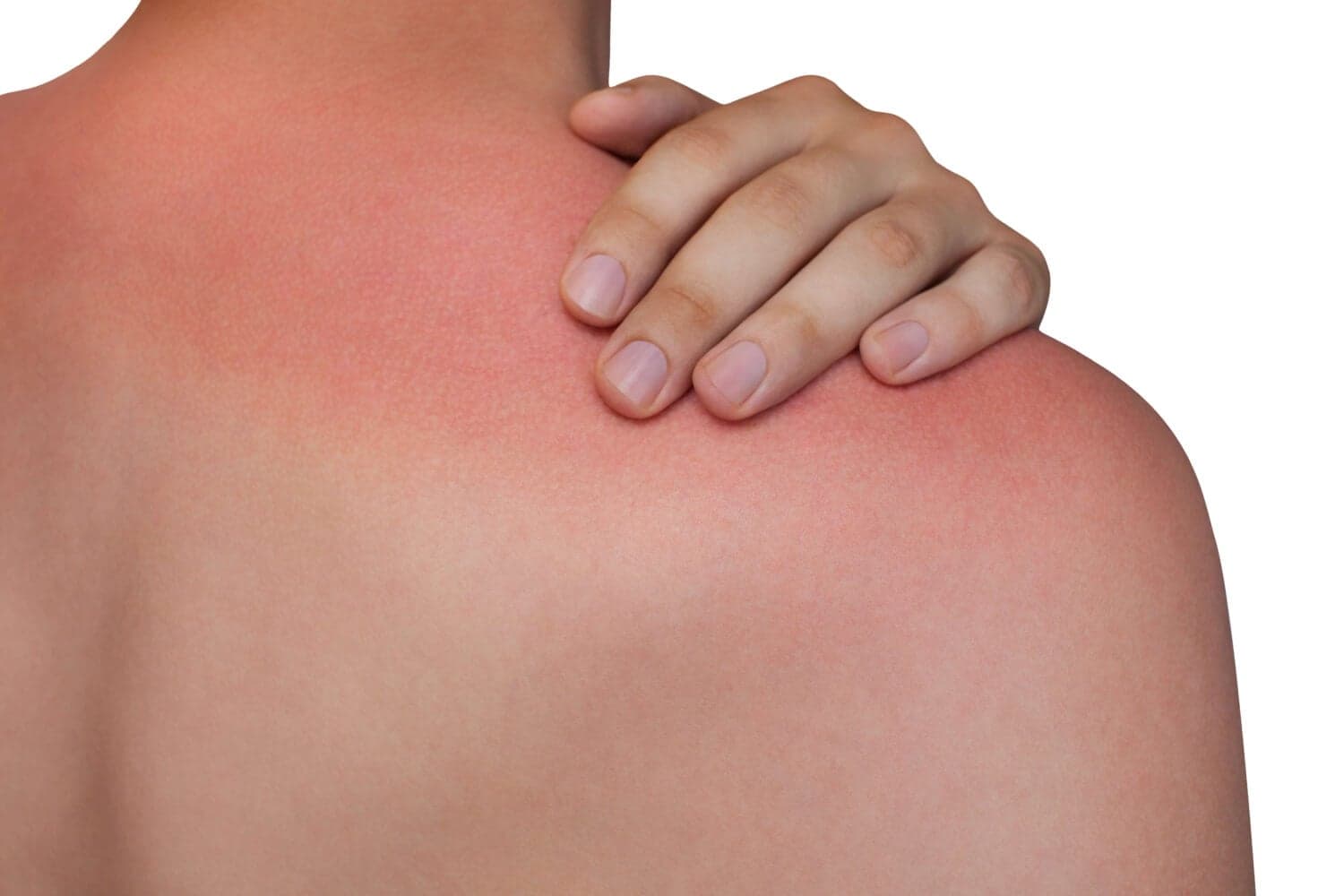 Sun Poisoning Explained: Symptoms, Prevention & Care