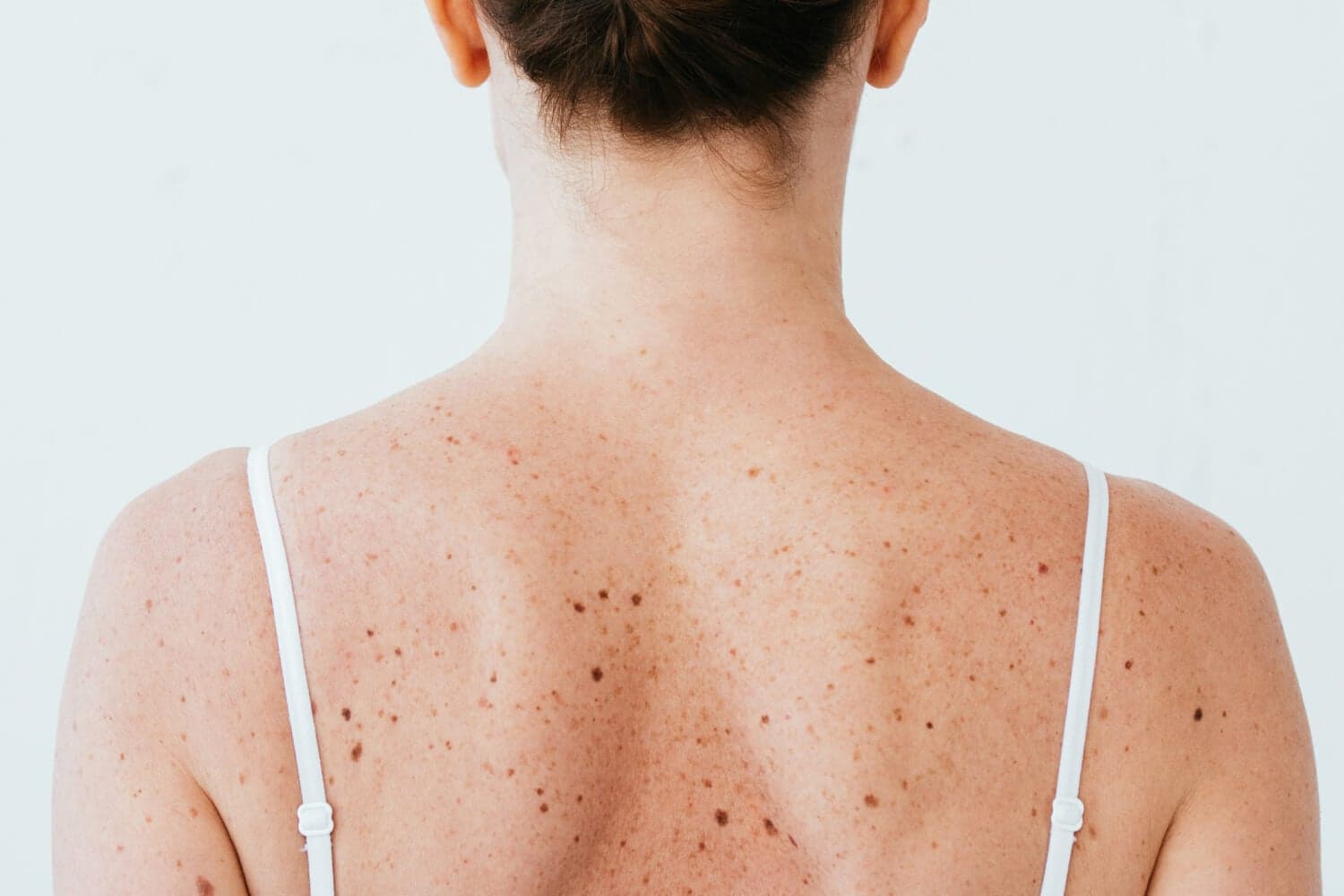 Pimples on Your Back? It's Probably Bacne Pimples on Your Back? It's Probably Bacne