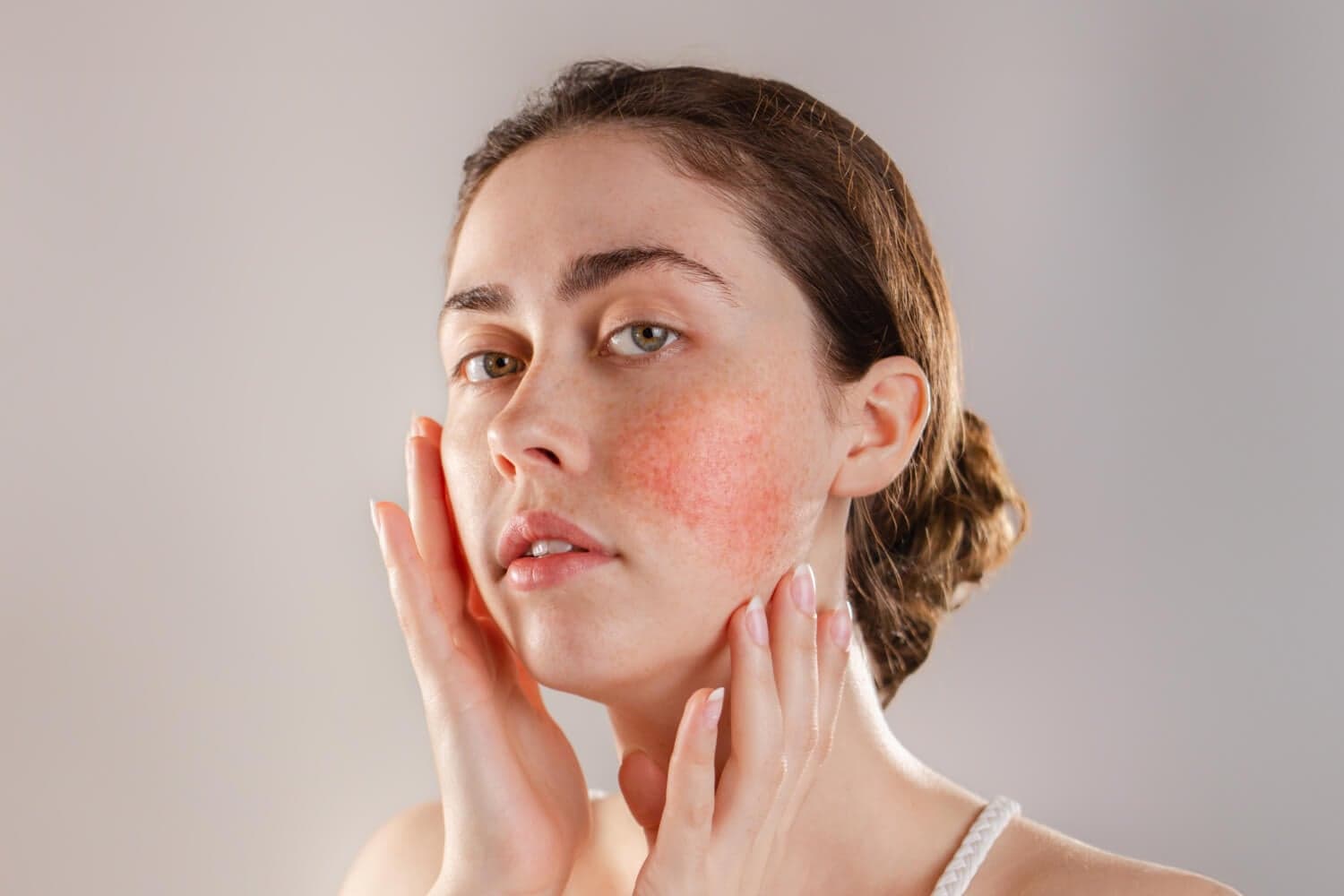 Bare-faced woman with hair tied back holding both hands to her jaw, a patch of red, irritated skin flushed across her right cheek. Bare-faced woman with hair tied back holding both hands to her jaw, a patch of red, irritated skin flushed across her right cheek.