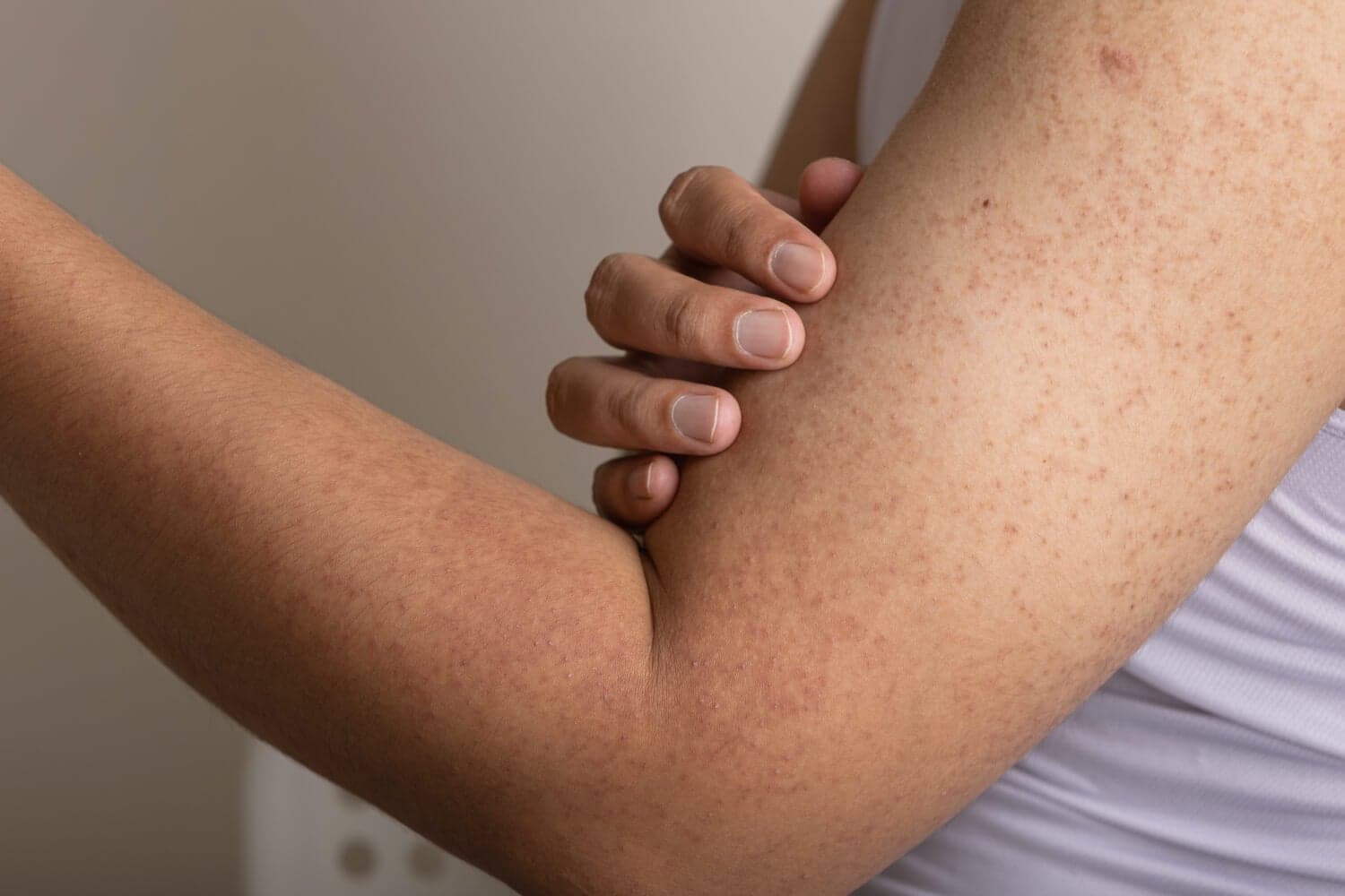 Creams for "Chicken Skin", aka Keratosis Pilaris Creams for "Chicken Skin", aka Keratosis Pilaris