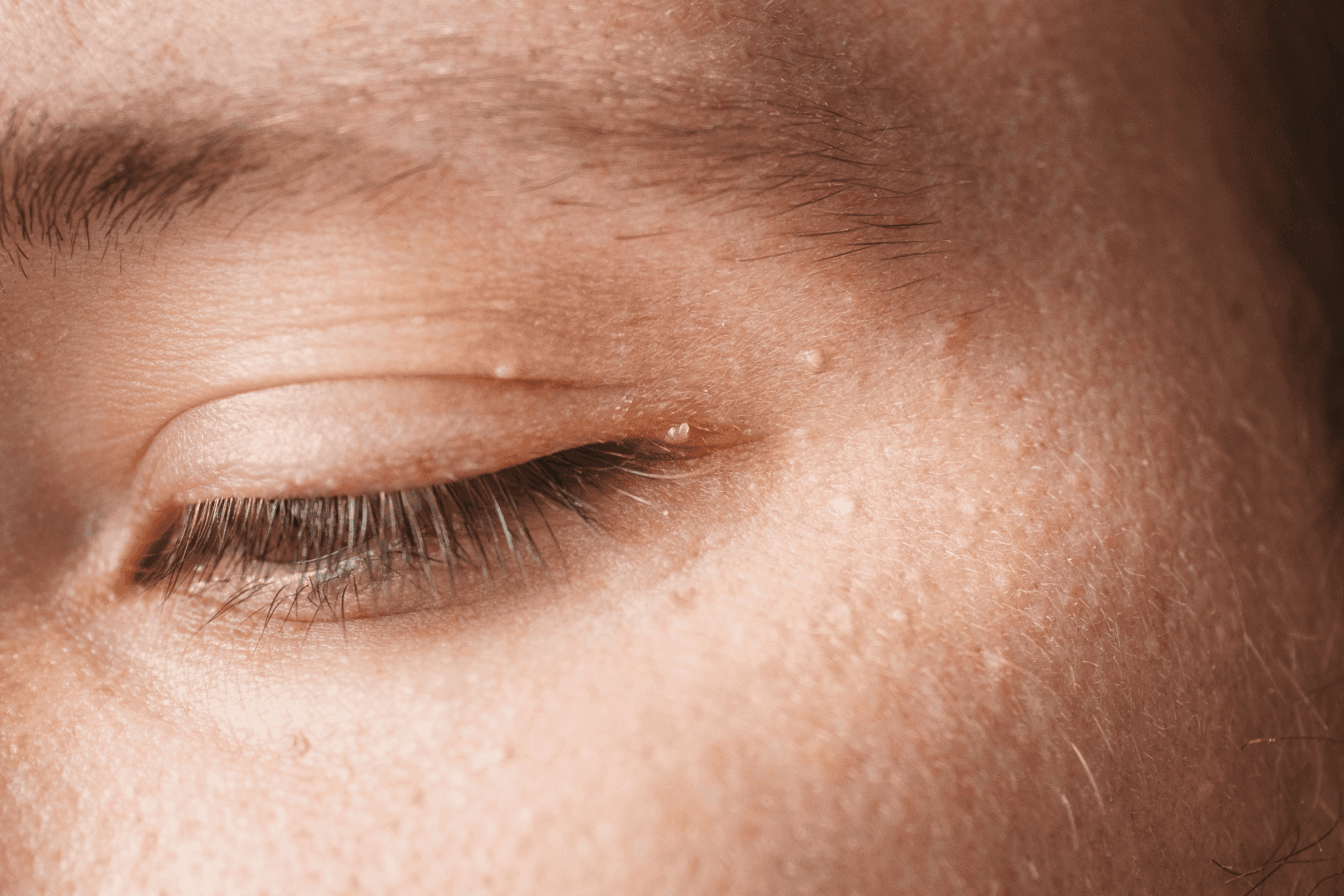 How to Prevent Milia Bumps: 3 Simple Tips How to Prevent Milia Bumps: 3 Simple Tips