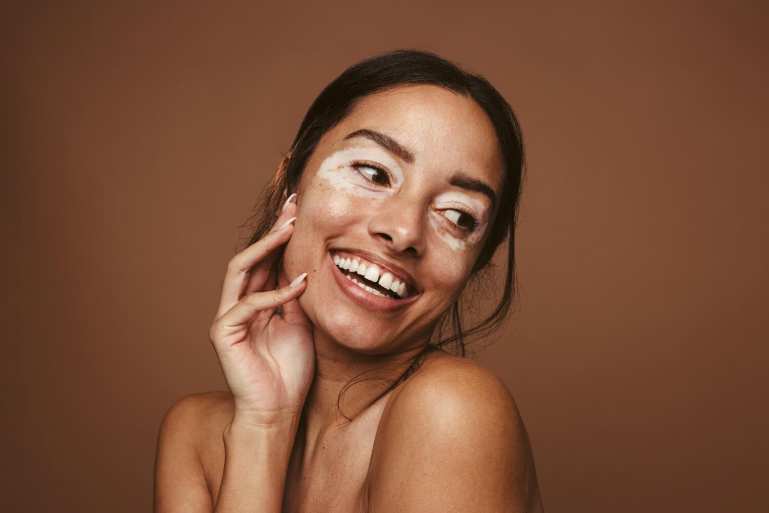 What is Vitiligo, & How Can You Manage It? What is Vitiligo, & How Can You Manage It?